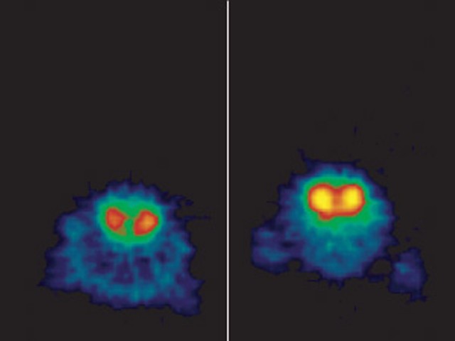A sample PET scan. The image on the right is brighter, which means it shows lower dopamine levels.