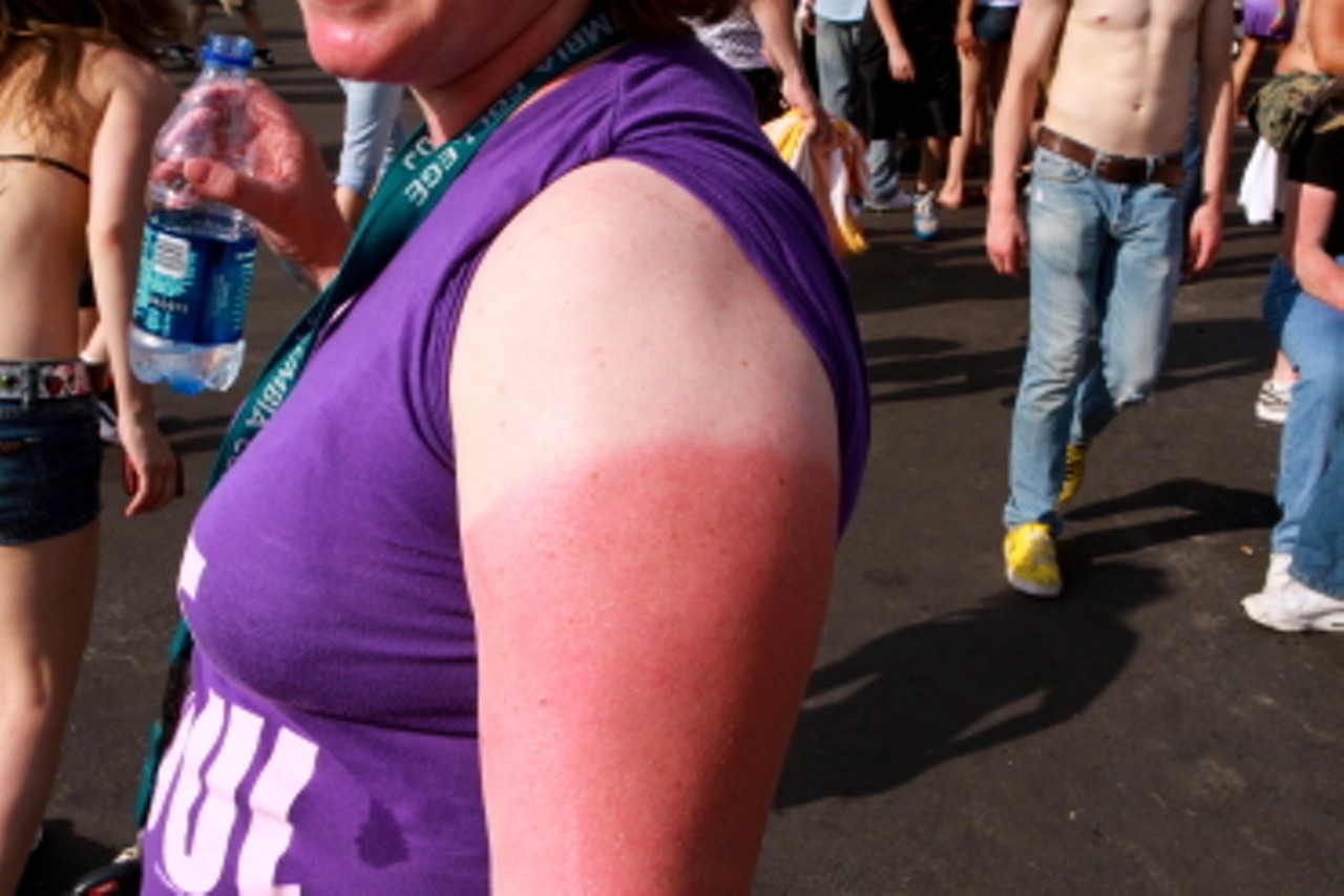 Finally, you can have an interesting sunburn story.