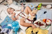 Owen Stark uses an artificial lung - Courtesy St. Louis Children's Hospital
