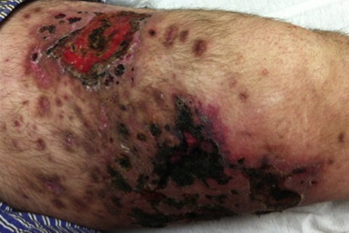 This is what Krokodil use looks like. - America Journal of Medicine