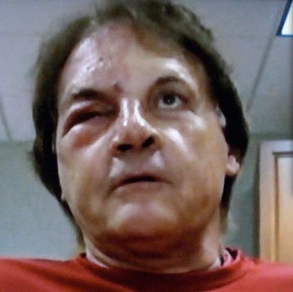 Sweet Jesus! What Happened to Tony La Russa's Face?