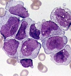 Leukemic cells, away from bone marrow, under the microscope.